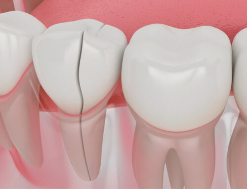 Incrustaciones dentales